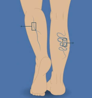 下肢靜脈曲張：四個考慮積極手術處理的時機