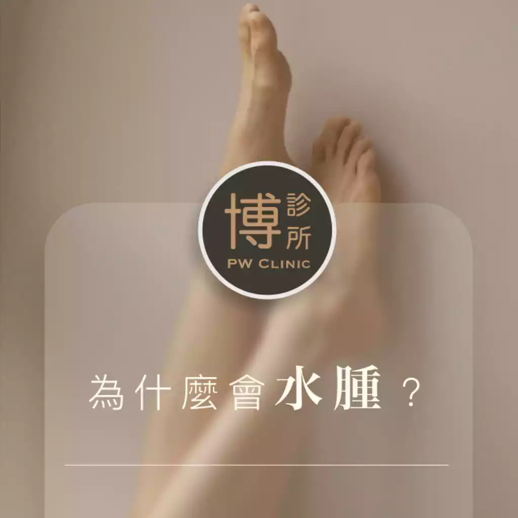 靜脈曲張常見的症狀_水腫