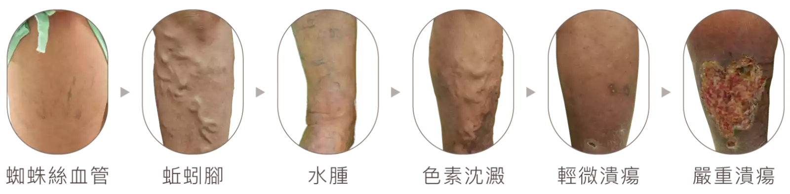 靜脈曲張症狀 | 博診所