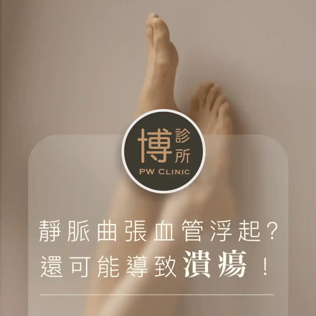 靜脈曲張血管浮起還可能導致潰瘍